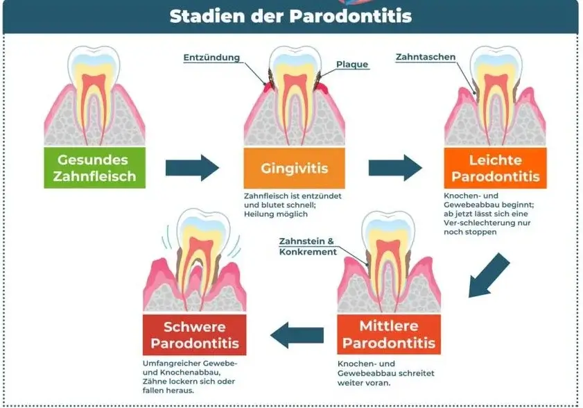 Grafische Darstellung der Parodontitis-Stadien, beginnend mit gesundem Zahnfleisch und endend mit schwerer Parodontitis.